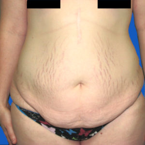 Tummy tuck before front view case 1535