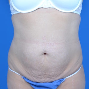 Patient before tummy tuck, front view case 1580