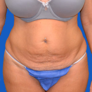 Front view of patient before tummy tuck case 1600