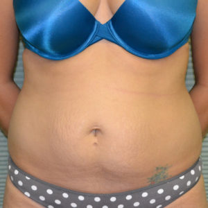 Front view of patient's abdomen and flanks before tummy tuck