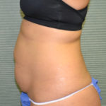 Left side of patient's abs before tummy tuck case 1431