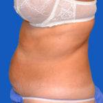Left side view of patient before tummy tuck procedure, case 1454