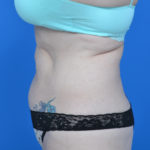 Left side view abs of patient before tummy tuck case 1459