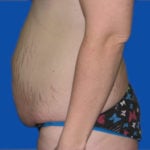Tummy tuck before left side view case 1535