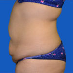 Left side view before tummy tuck