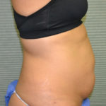 Right side of patient's abs before tummy tuck case 1431