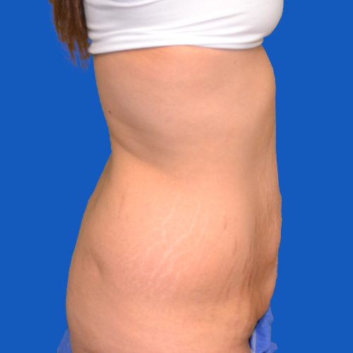 Tummy tuck before right side case 1440