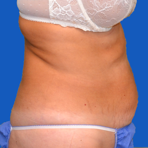 Before tummy tuck right view case 1454