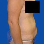 Right side before tummy tuck case 1493