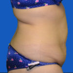 Right side view before tummy tuck