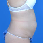 Patient before tummy tuck, right side view, case 1580