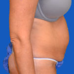 Right side view of patient before tummy tuck case 1600