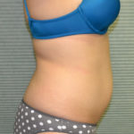 Before tummy tuck, patient's right side