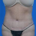 After tummy tuck front view case 1445