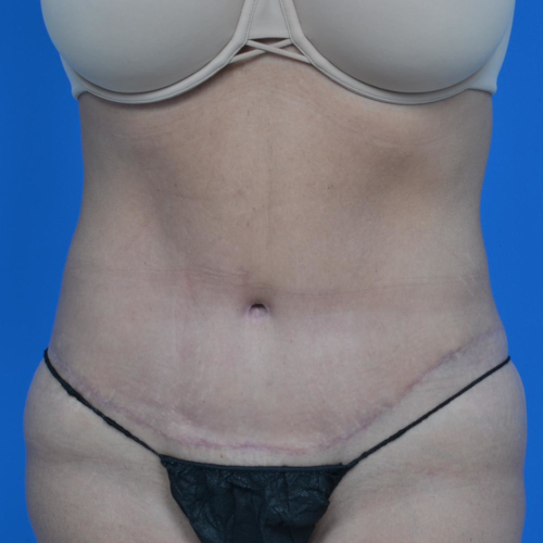 After tummy tuck front view case 1445