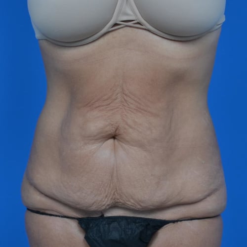 Before tummy tuck front view case 1445