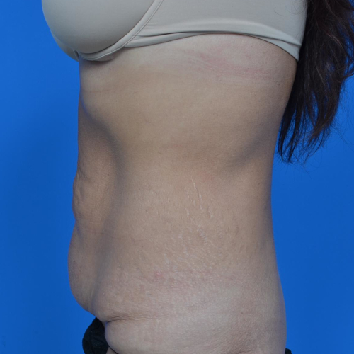 Before tummy tuck left side view case 1445
