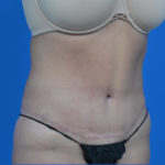 After tummy tuck oblique view case 1445
