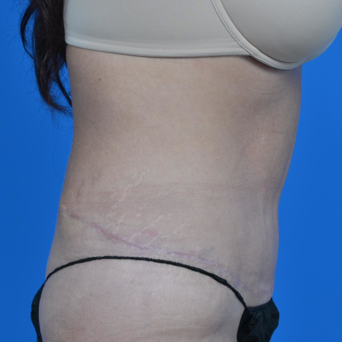 After tummy tuck right side view case 1445