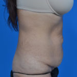 Before tummy tuck right side view case 1445