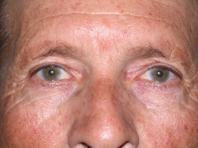 Upper eyelid surgery on middle aged male case 935