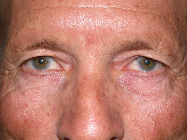 Before upper eyelid surgery on male patient case 935