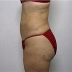 Female patient's abdomen after lipo case 2232