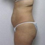 Female patient's abdomen before liposuction, side view case 2232