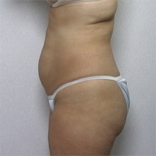 Female patient's abdomen before liposuction, side view case 2232