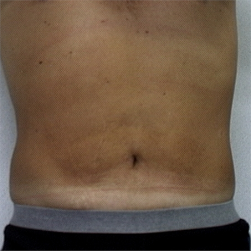 Male patient's abdomen front view after liposuction case 2242