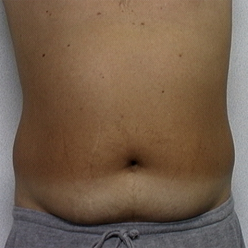 Male patient's abdomen before liposuction case 2242