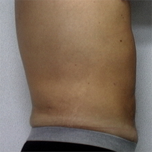 Abdomen of male patient after liposuction case 2242