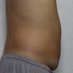 Side view of patient's abdomen before liposuction case 2242