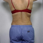 Back view of female patient's flanks after liposuction, case 2232