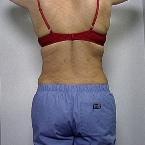 Back view of female patient's flanks after liposuction, case 2232