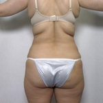 Back view of female patient's flanks before liposuction, case 2232
