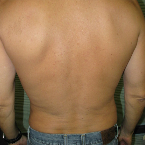 Male patient's flanks after liposuction