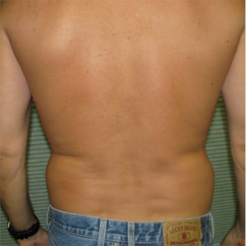 Male patient's flanks before liposuction