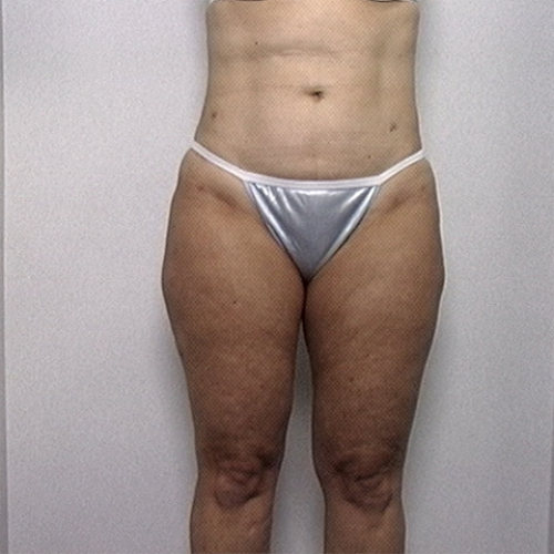 Female patient's thighs after liposuction, front view case 2238