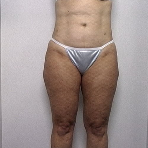 Female patient's thighs after liposuction, front view case 2238