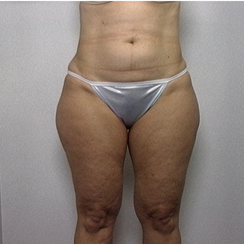 Female patient's thighs before liposuction, front view case 2238