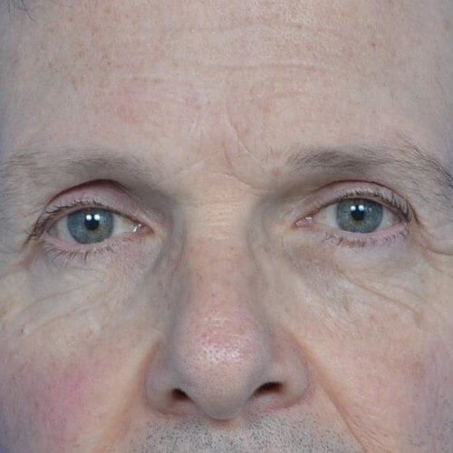 Blepharoplasty left after front 0214