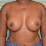 Breast augmentation after front 0706