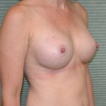 Breast augmentation after oblique 0523