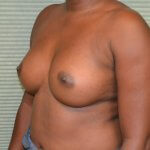 Breast augmentation after oblique 0706