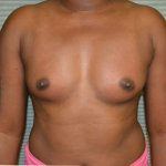 Breast augmentation before front 0706