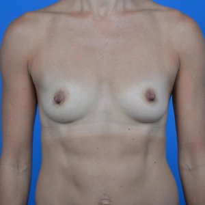 Breast augmentation before front 1019