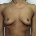 Breast augmentation before front 1122