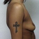 Breast augmentation before side 1122