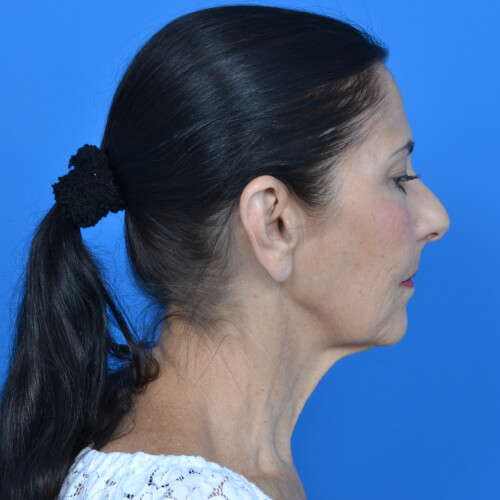 Facelift before right side view